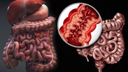 Crohn hastalığı nedir? Crohn hastalığının belirtileri nelerdir? Crohnun tedavisi var mıdır?