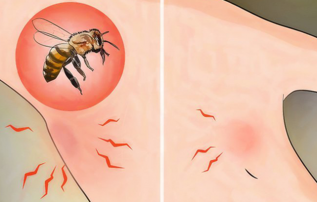 Arı alerjisi nedir ve belirtileri neledir? Arı sokmasına iyi gelen doğal yöntemler