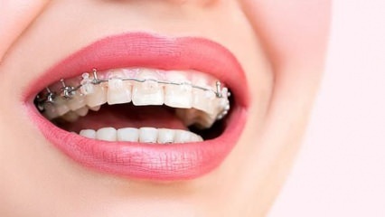 Diş teli neden takılır? Diş teli çeşitleri nelerdir?