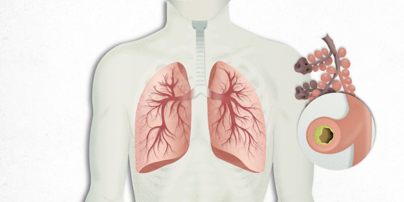 akciğerlere yerleşen virüs zatürre ile karıştırılır