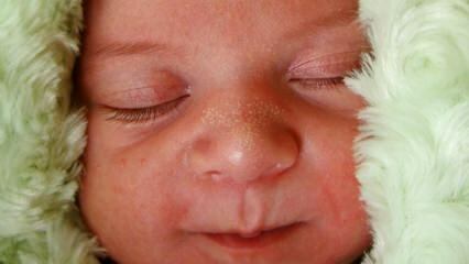 Bebeklerde beyaz nokta neden çıkar?