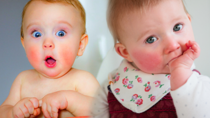 Kızarık yanaklı bebeklerde dikkat! Tokatlanmış yanak sendromu ve belirtileri