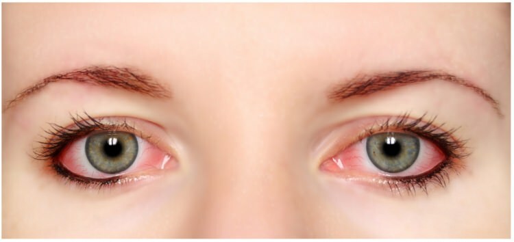 Rimel ve eyeliner gözde alerji yapar mı?