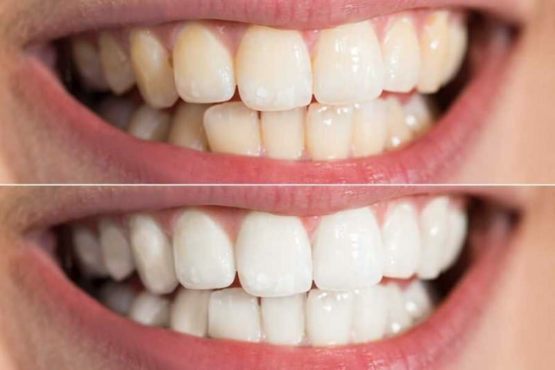 diş dibi kararma genetiksel yapıyla oluşabilir