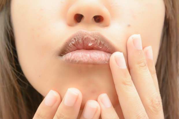 kansızlık dudak kuruluğuna neden olur