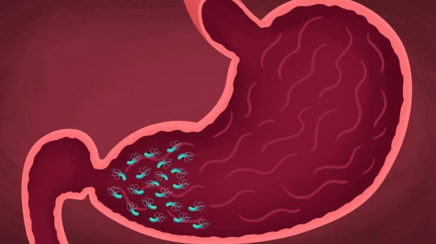bazı virüs ve bakteriler gastrite neden oalbilir