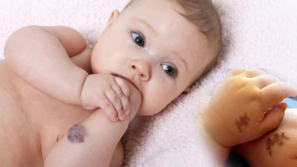 Bebeklerde doğum lekesi neden olur, kalıcı mı? Doğum lekesi çeşitleri neler? Saraçoğlu'ndan kür