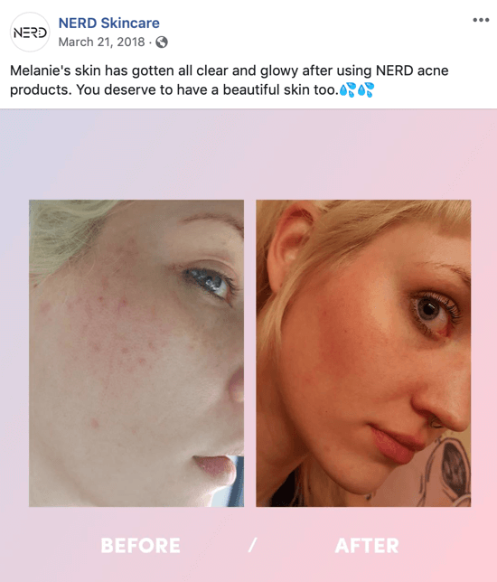 Nerd Skincare'in, ürünlerinin satın alınmasını teşvik eden sosyal medya için bir resim gönderisi oluşturmak için öncesi ve sonrası bir resmi nasıl kullandığına bir örnek.