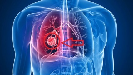 Akciğer kanserinin belirtileri: Akciğer kanserinin evreleri!