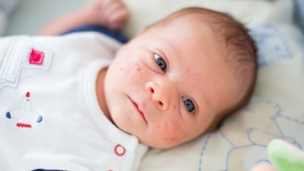 Bebeğin yüzündeki sivilceler nasıl geçer? Sivilce (Milia) kurutma yöntemleri