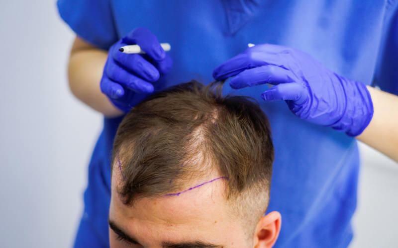 Saç dökülmesi tedavisinde saç ektirmek caiz mi? Protez saç nedir? Protez saç gusle engel mi