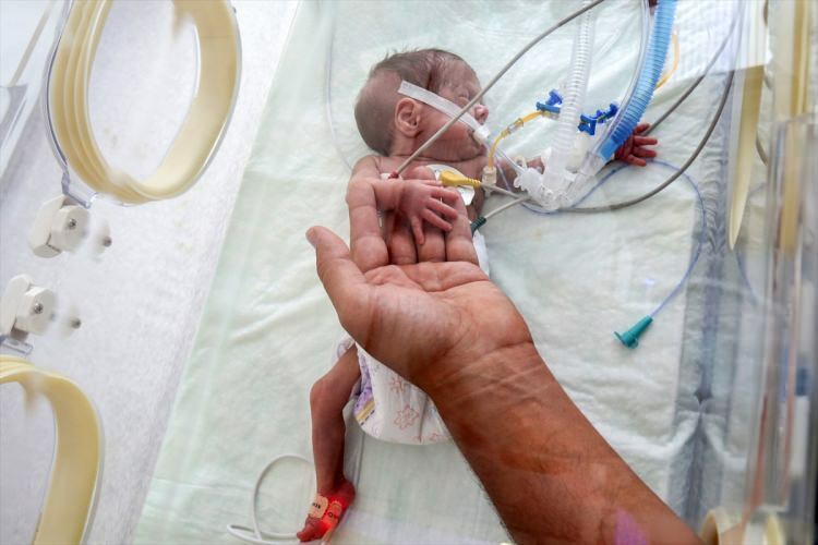 'Mucize bebek' ameliyatla hayatta kalmayı başardı