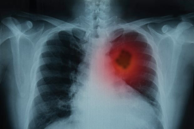 Akciğer kanserinin belirtileri nelerdir? Akciğer kanseri tedavisi var mıdır? Akciğer kanserini önlemek için...