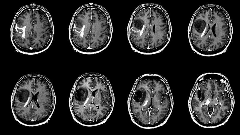 Beyin tümörü neden olur? Beyin tümörü belirtileri nelerdir? Beyin tümörü tedavisi zor mudur?