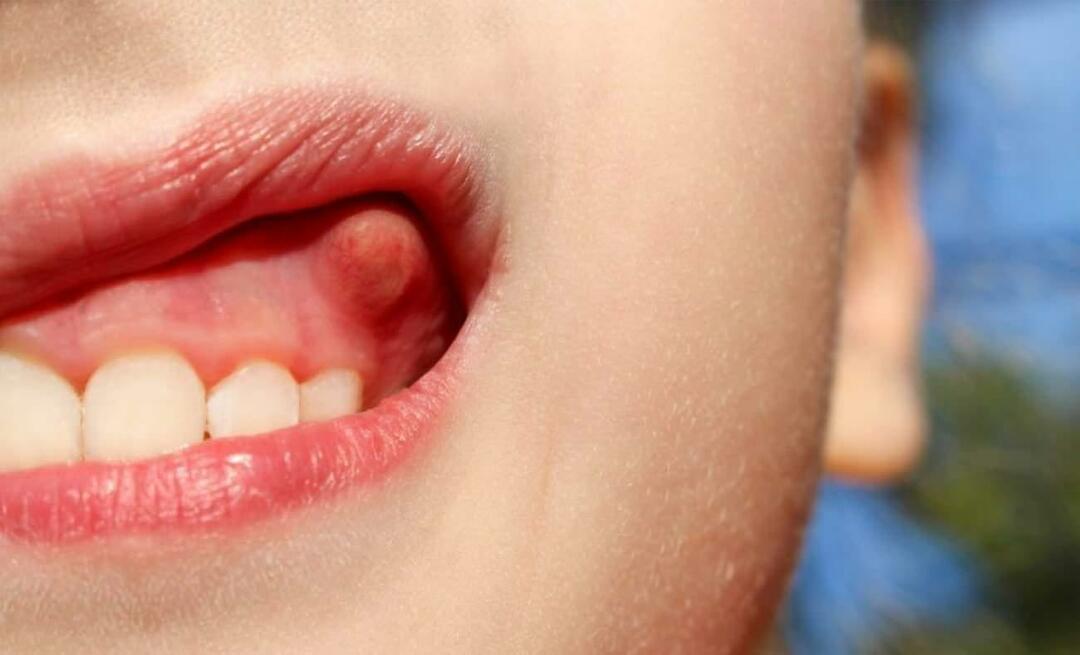 Diş neden apse yapar ve belirtileri nelerdir? Diş apsesi nasıl tedavi edilir?