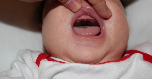 Bebeklerde damak düşmesi nedir, neden olur? Belirtileri ve tedavisi...