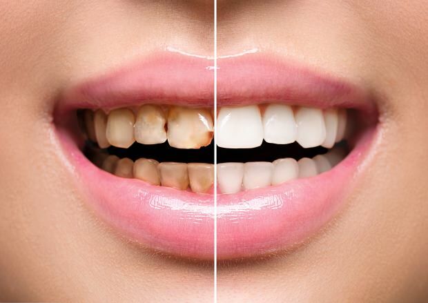 Sağlıksız beslenme sonucu hem diş renginde bozulma hem de diş kaybı meydana gelir