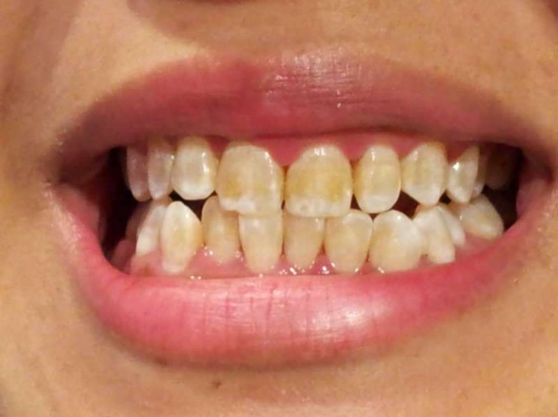 diş dibi kararmaya başlayan bir insanın diş görüntüsü