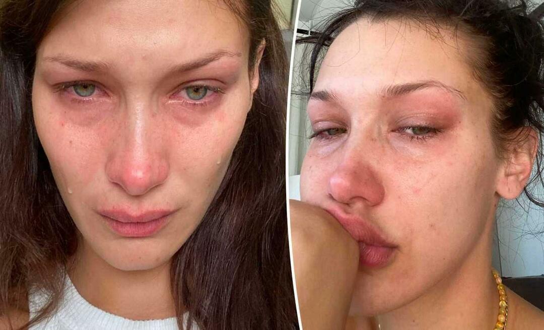 Bella Hadid'in hastalığı yüzünden vücudu morardı!