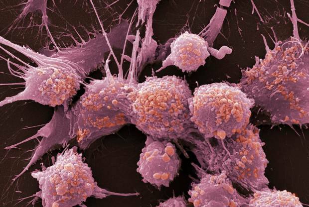 Kanser nedir? Kanser belirtileri nelerdir? Kaç çeşit kanser vardır? Kanser nasıl önlenir?